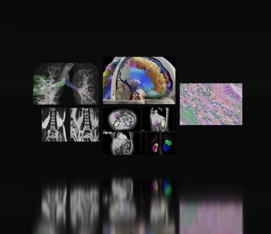 AI and Federated Learning Enhance Cancer Detection at Medical Centers medical imaging scans