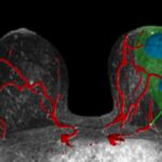 AI-Driven 3D Models Aid Surgeons in Locating Breast Cancer Startup Helps Surgeons Target Breast Cancers With AI-Powered 3D Visualizations