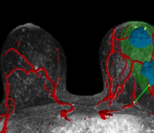 AI-Driven 3D Models Aid Surgeons in Locating Breast Cancer Startup Helps Surgeons Target Breast Cancers With AI-Powered 3D Visualizations